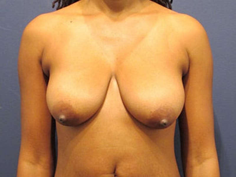Breast Lift Before & After