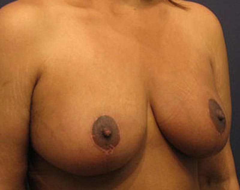 Breast Lift Before & After