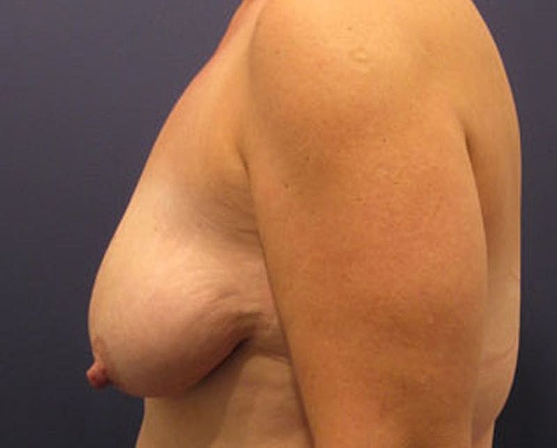 Breast Lift Before & After