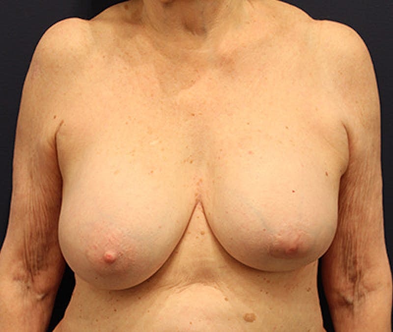Breast Lift Before & After