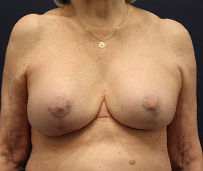 Breast Lift Before & After