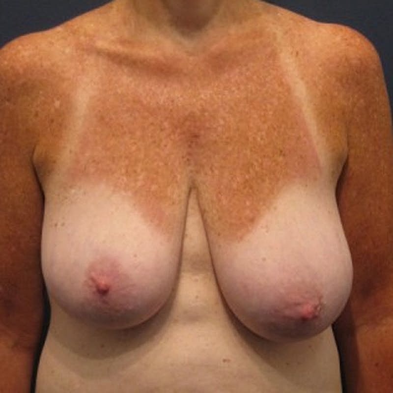 Breast Lift Before & After
