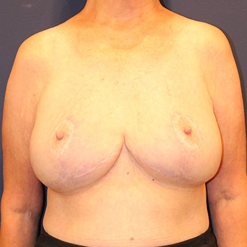 Breast Lift Before & After