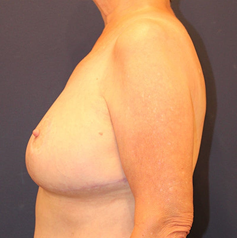 Breast Lift Before & After