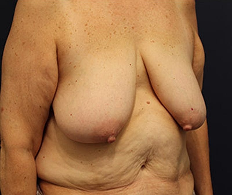 Breast Lift Before & After