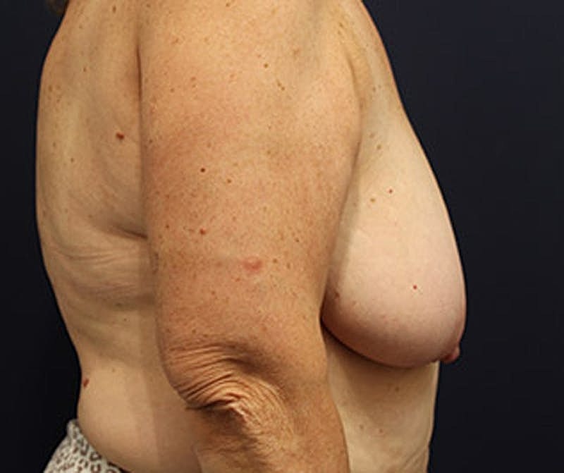 Breast Lift Before & After