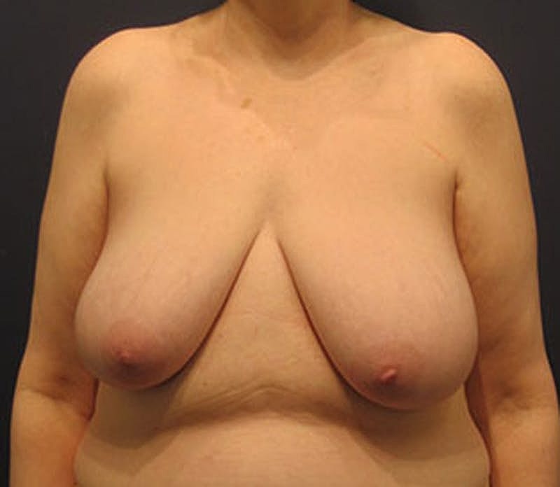 Breast Lift Before & After