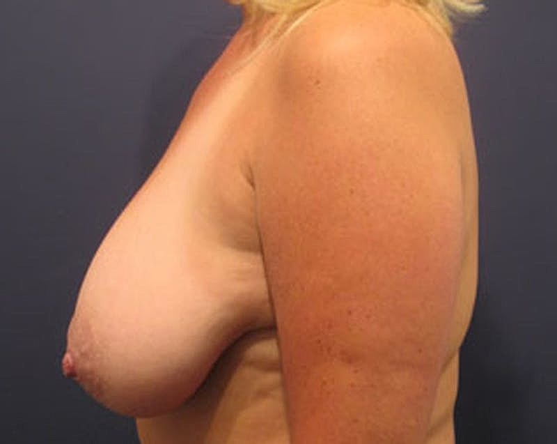 Breast Lift Before & After