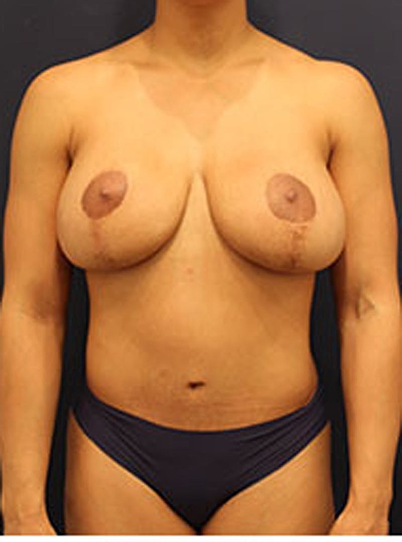 Breast Lift Before & After
