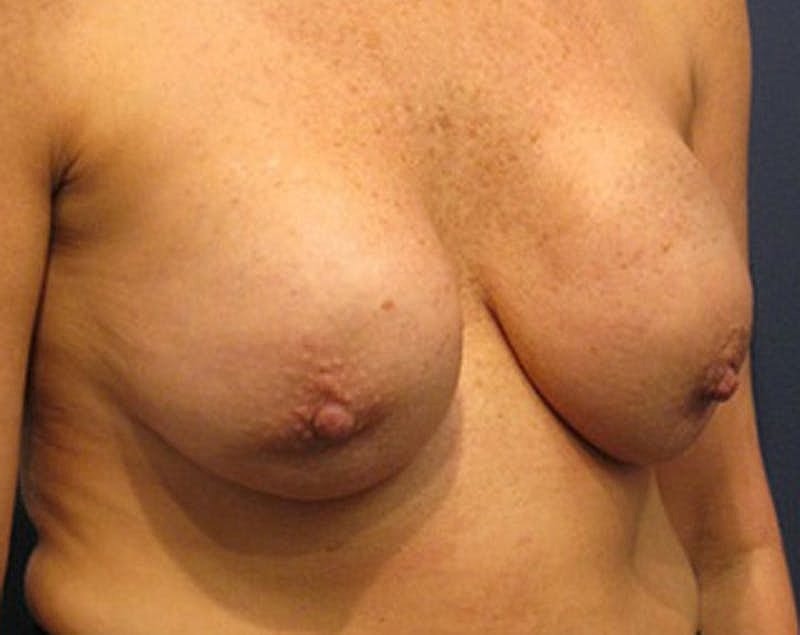 Breast Lift Before & After