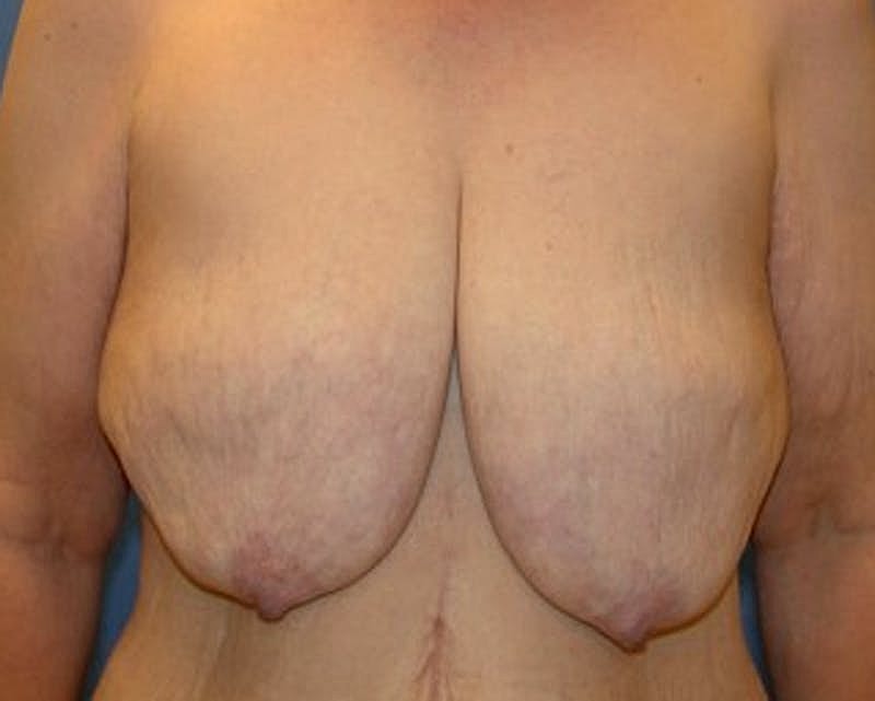 Breast Lift Before & After