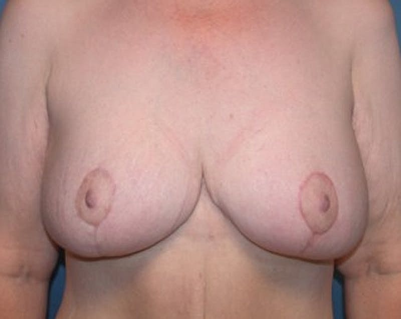 Breast Lift Before & After