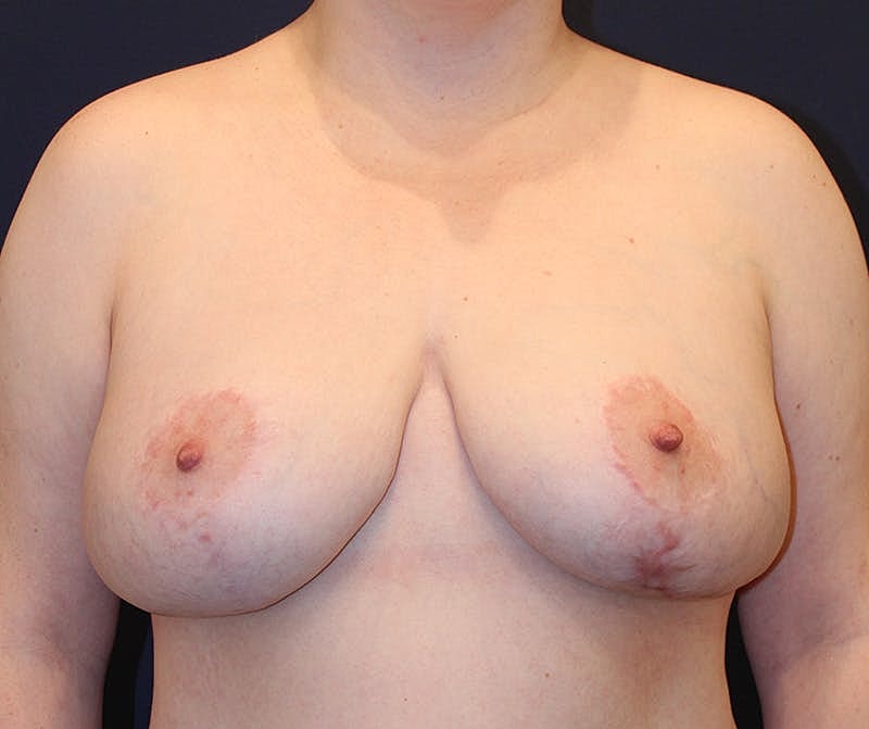 Breast Lift Before & After