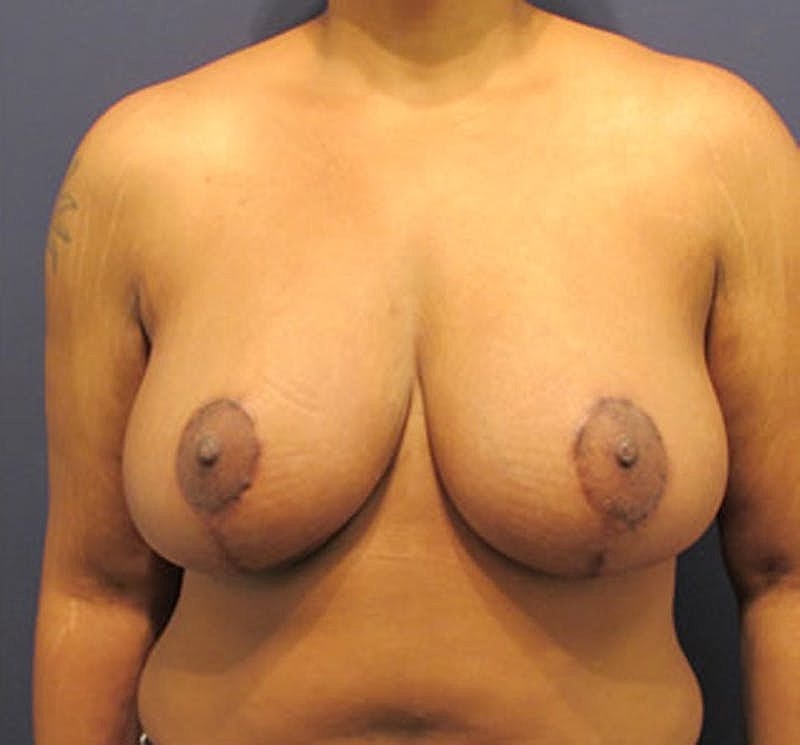 Breast Lift Before & After