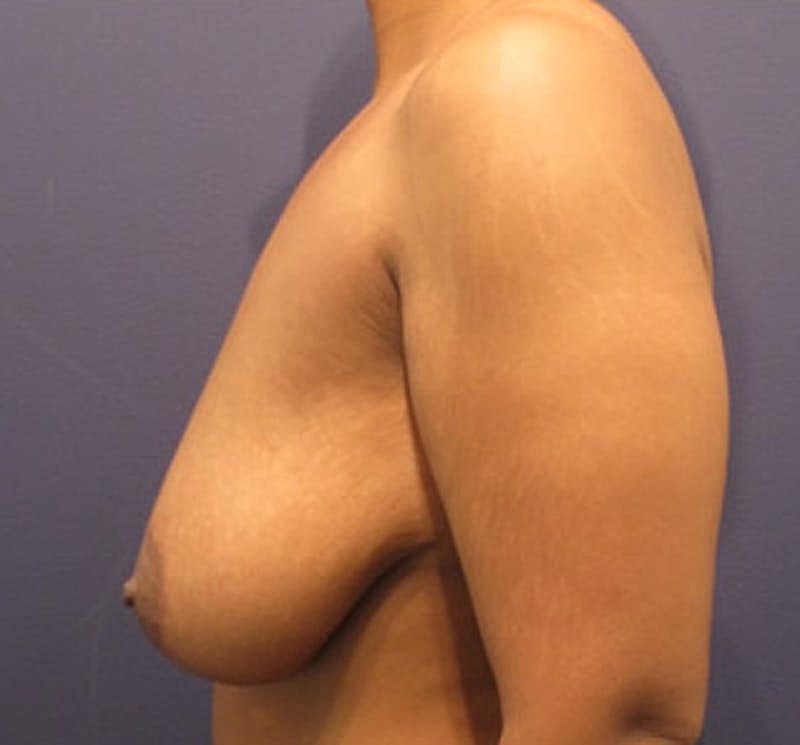 Breast Lift Before & After