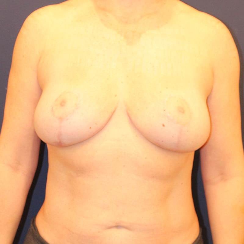 Breast Lift Gallery Before & After