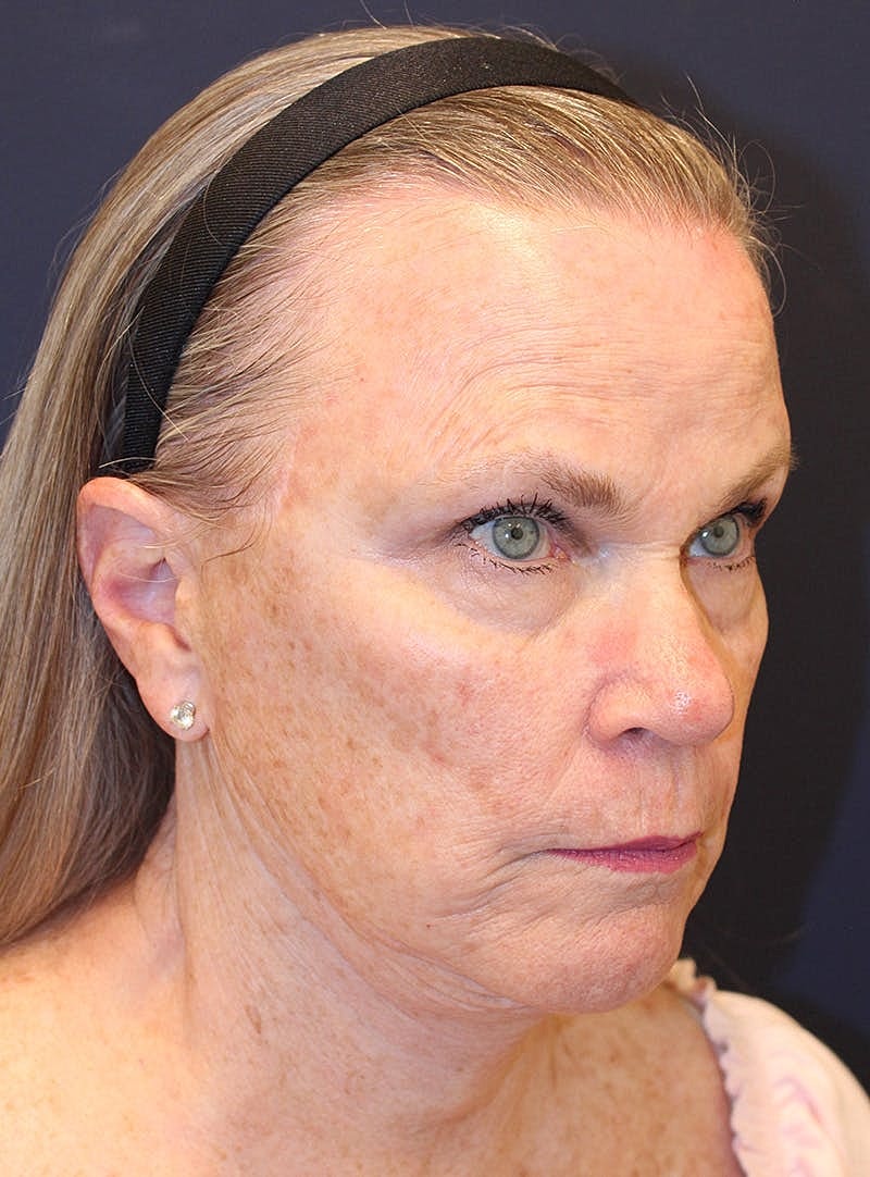 Peels Before & After