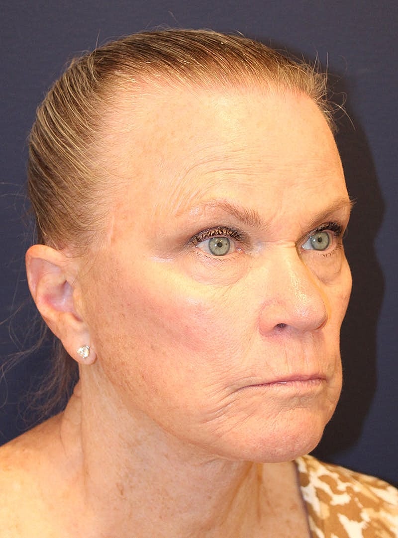 Peels Before & After