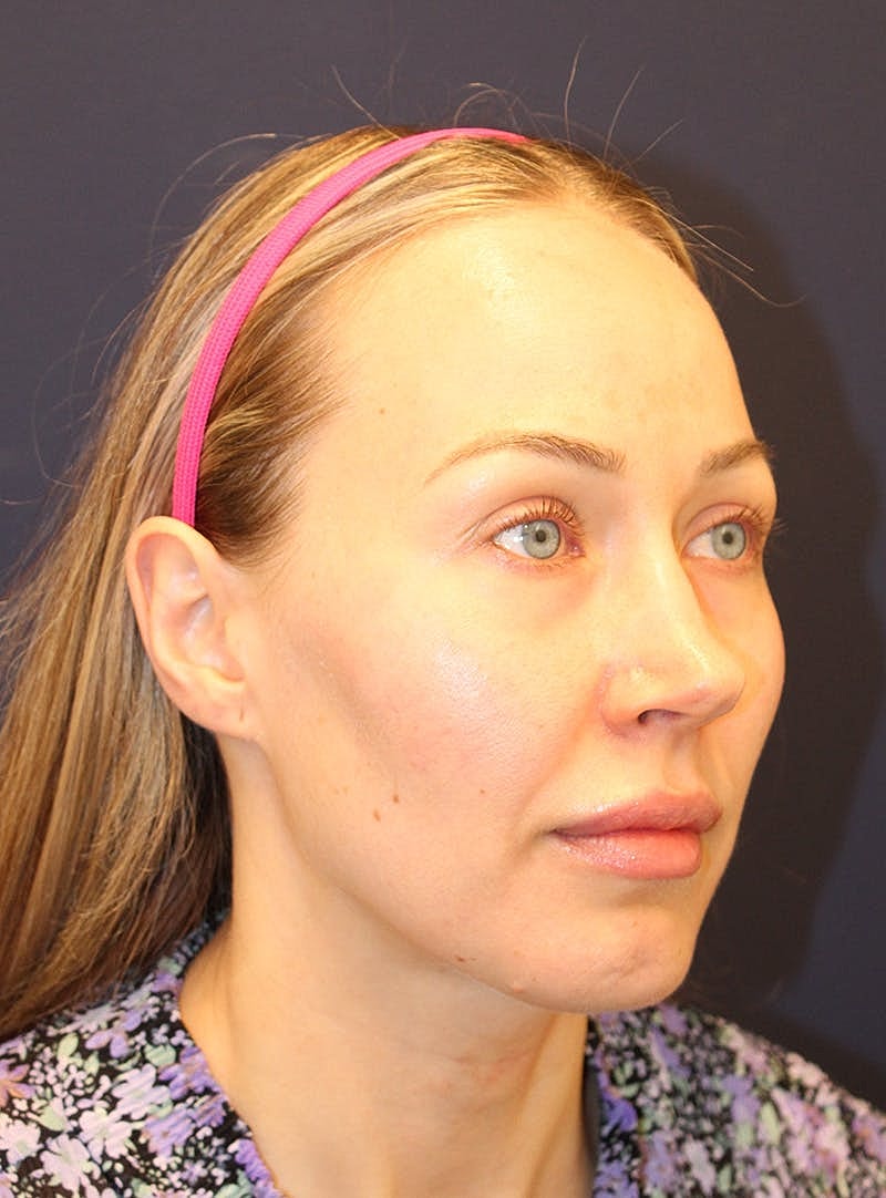 Peels Before & After