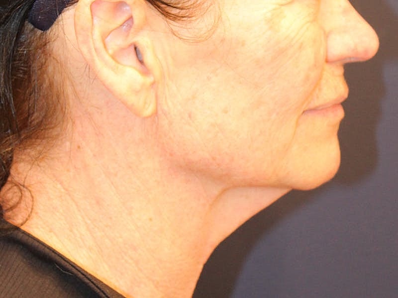 Peels Before & After