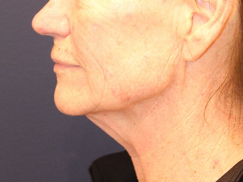 Peels Before & After