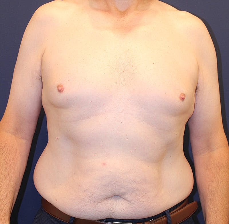 Emsculpt Neo Before & After