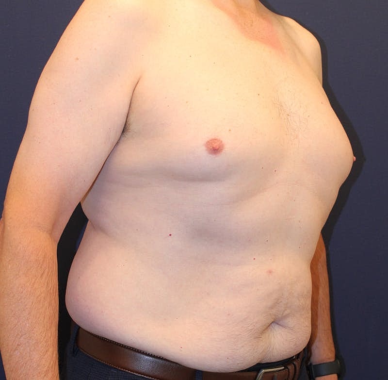 Emsculpt Neo Before & After