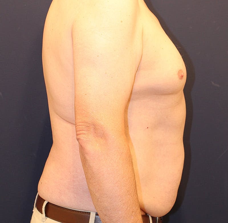 Emsculpt Neo Before & After