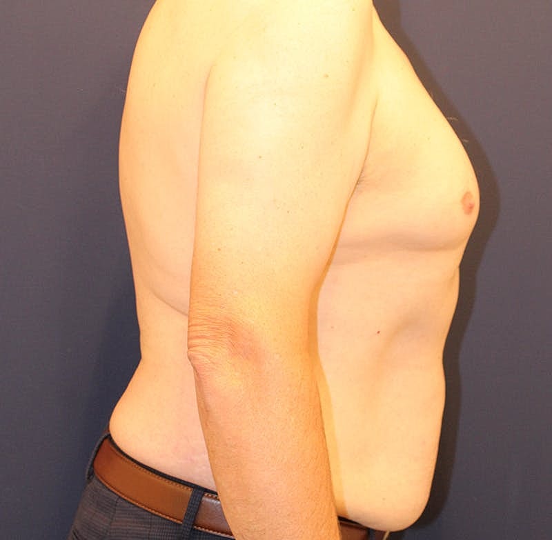 Emsculpt Neo Before & After