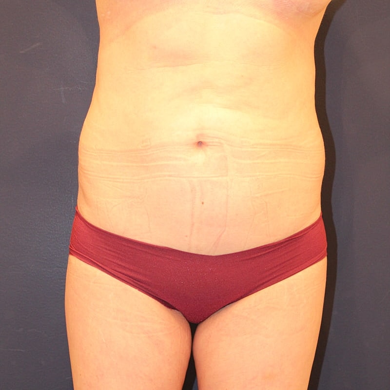 Emsculpt Neo Gallery Before & After