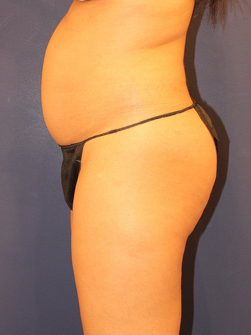 Emsculpt Neo Before & After