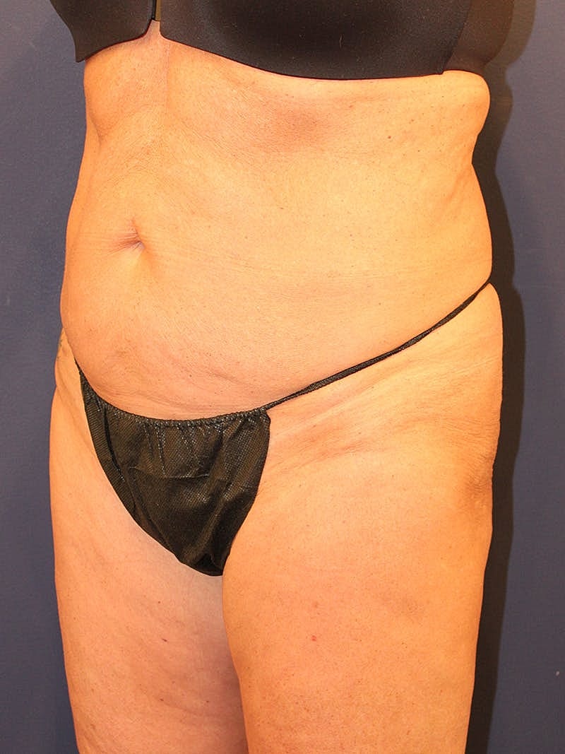 Emsculpt Neo Before & After