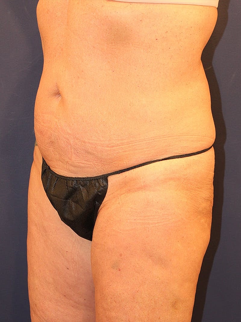 Emsculpt Neo Before & After