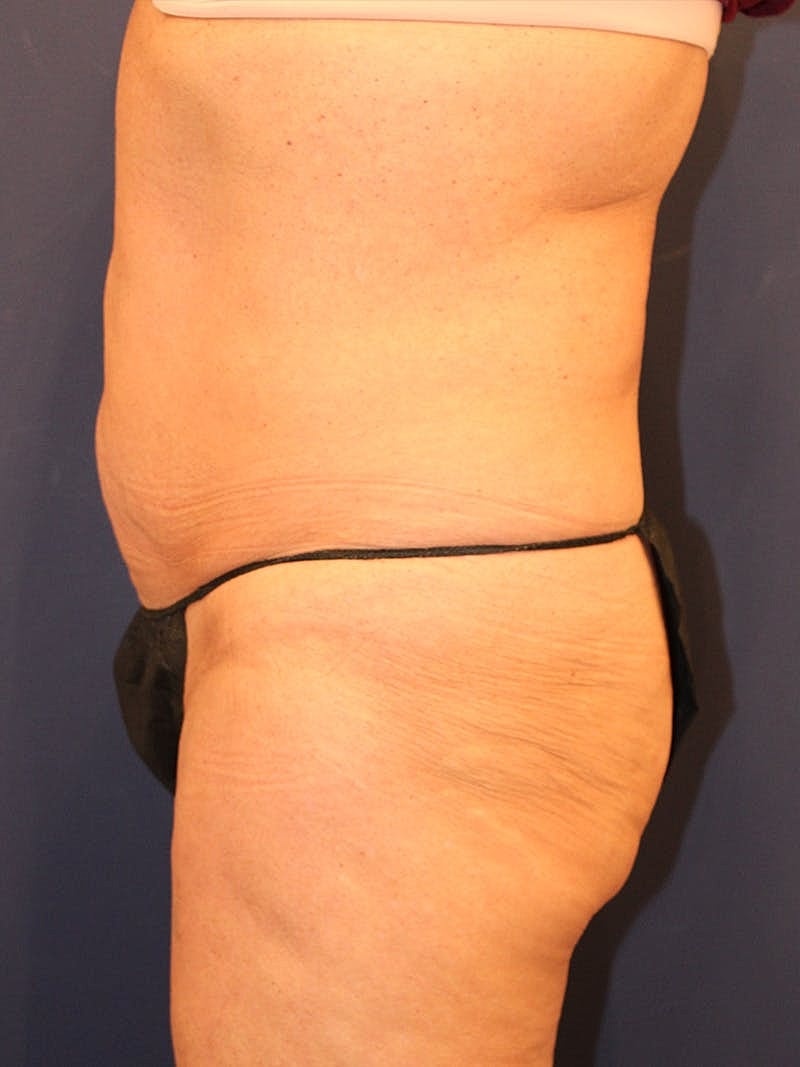 Emsculpt Neo Before & After