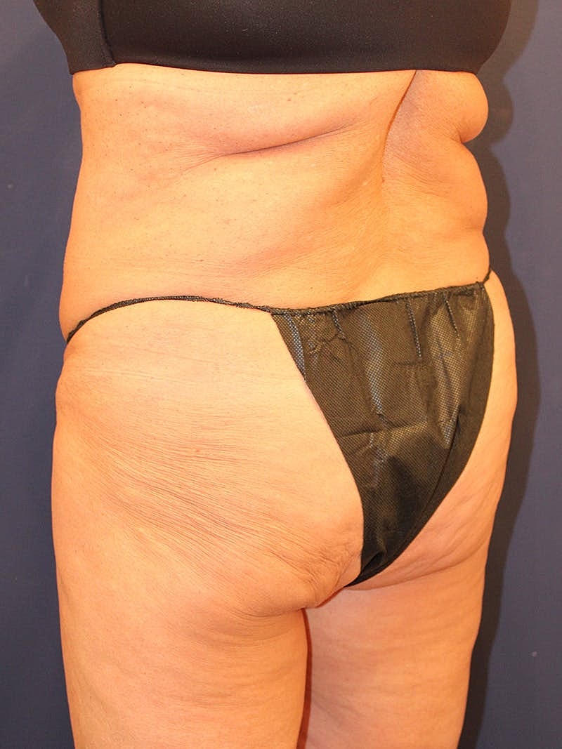 Emsculpt Neo Before & After