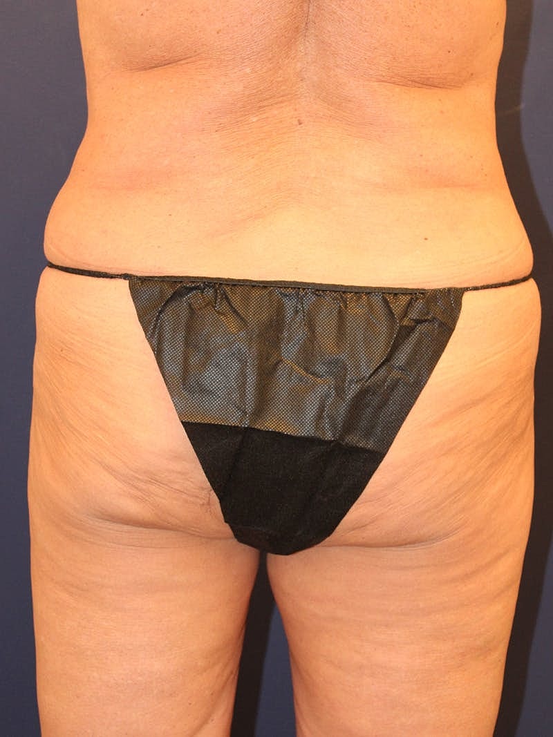 Emsculpt Neo Before & After