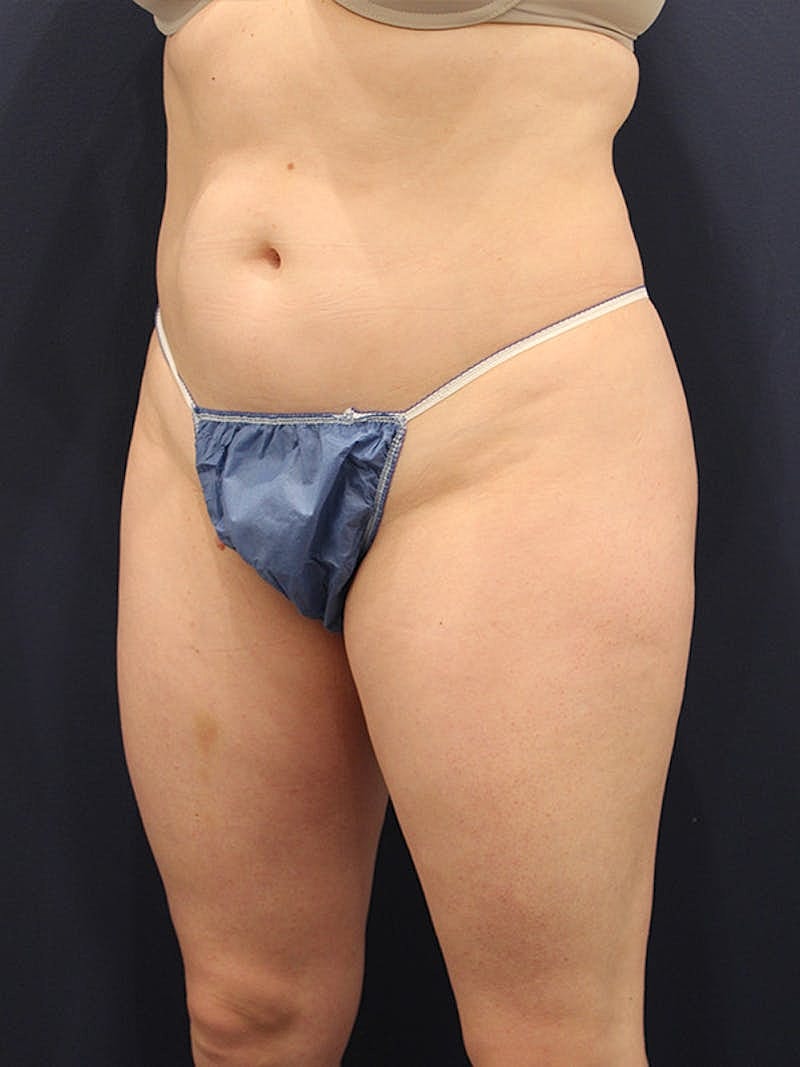 Emsculpt Neo Before & After