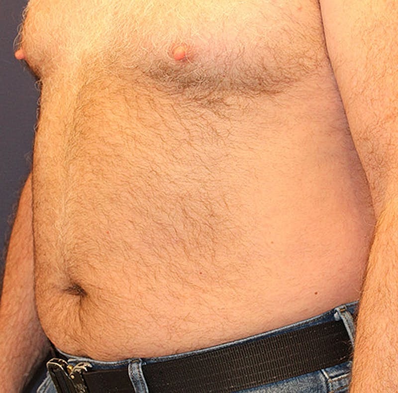 Emsculpt Neo Before & After