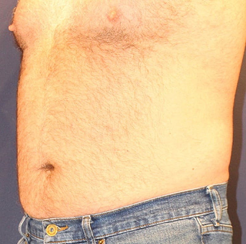 Emsculpt Neo Before & After