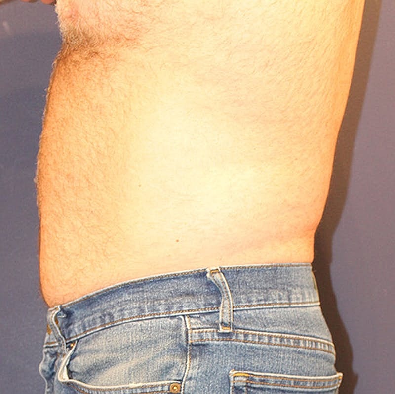 Emsculpt Neo Before & After