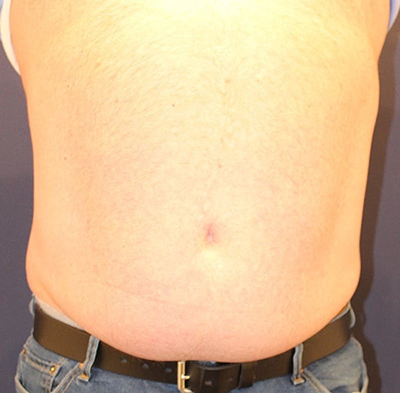 Emsculpt Neo Before & After