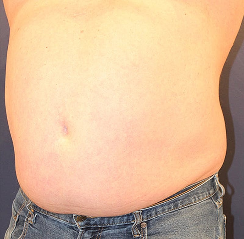 Emsculpt Neo Before & After