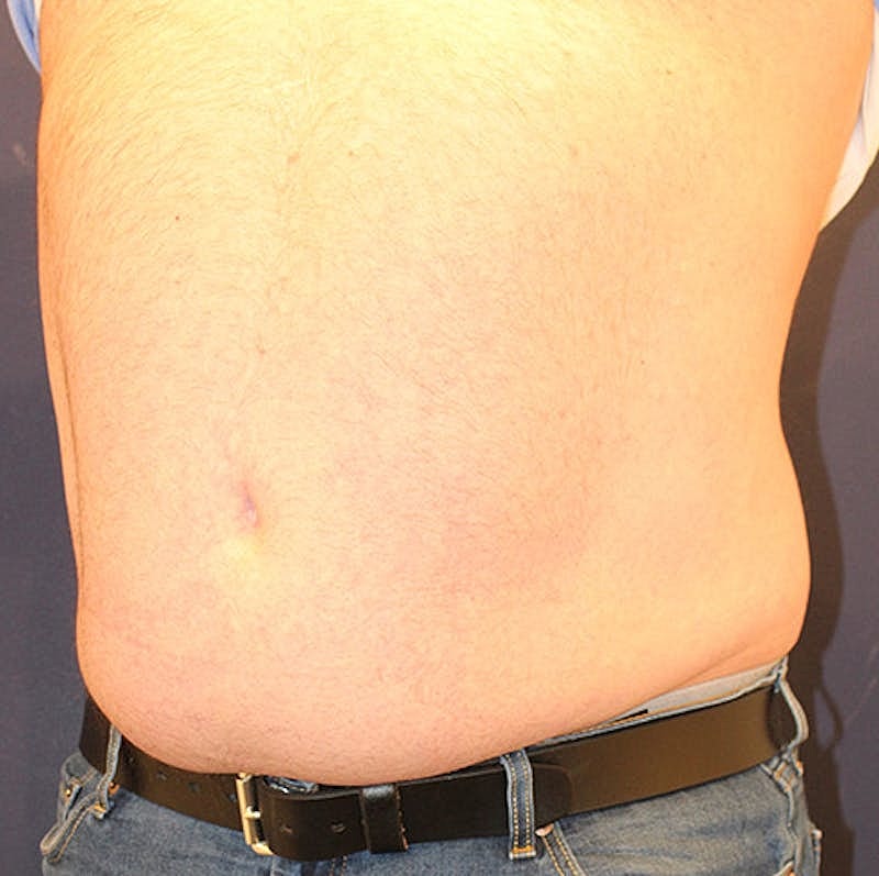 Emsculpt Neo Before & After