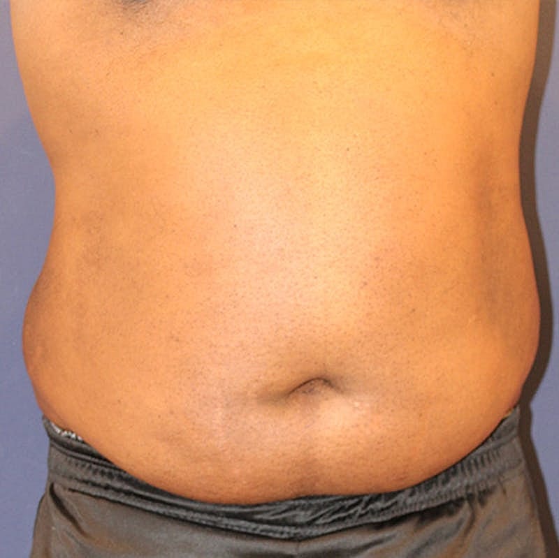 Emsculpt Neo Before & After