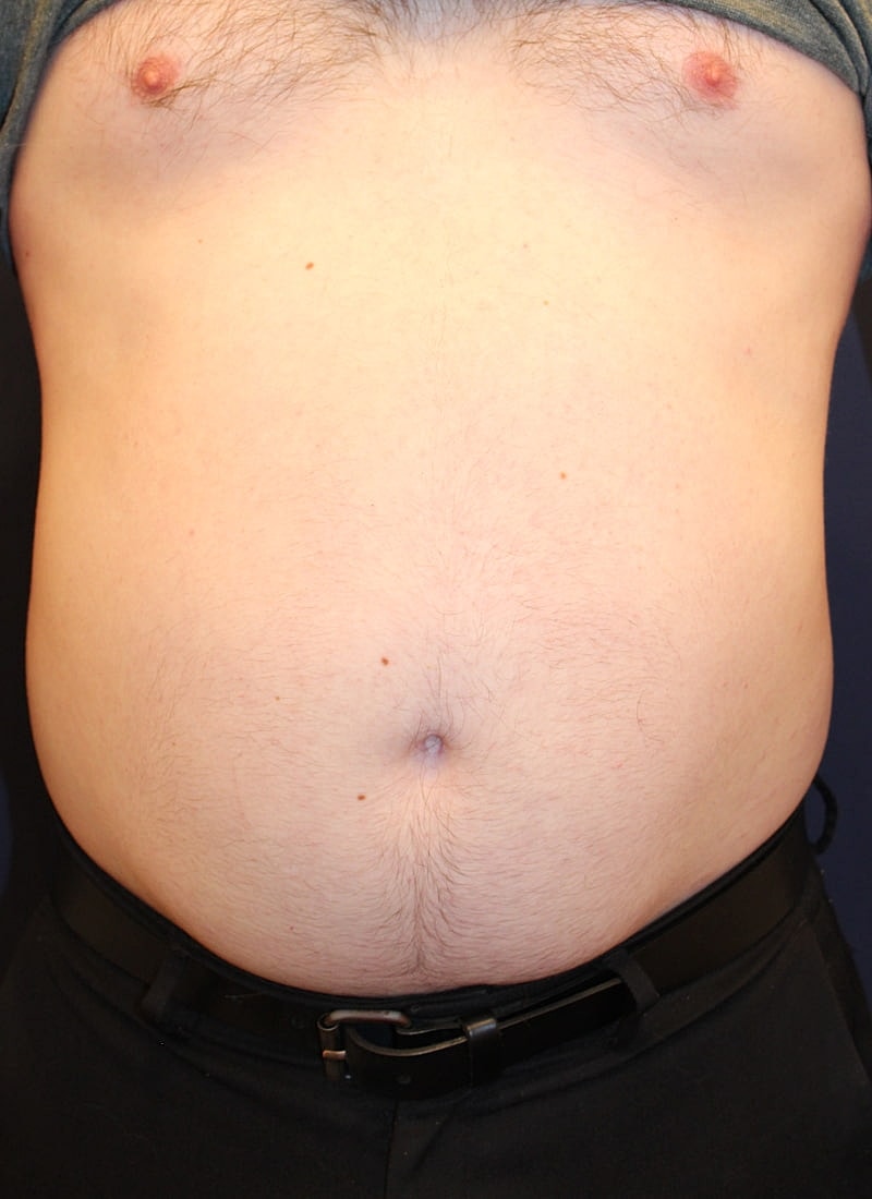 Emsculpt Neo Gallery Before & After