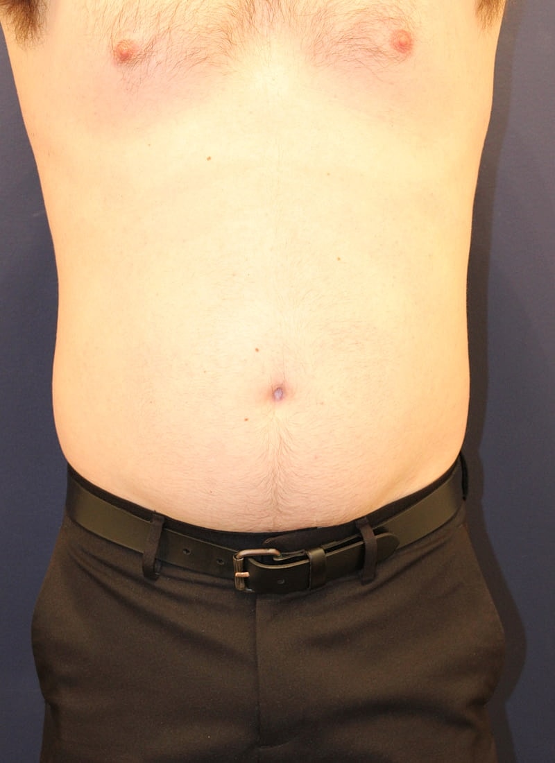 Emsculpt Neo Gallery Before & After