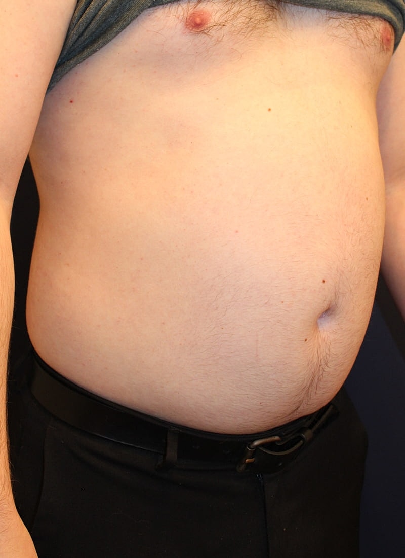 Emsculpt Neo Gallery Before & After