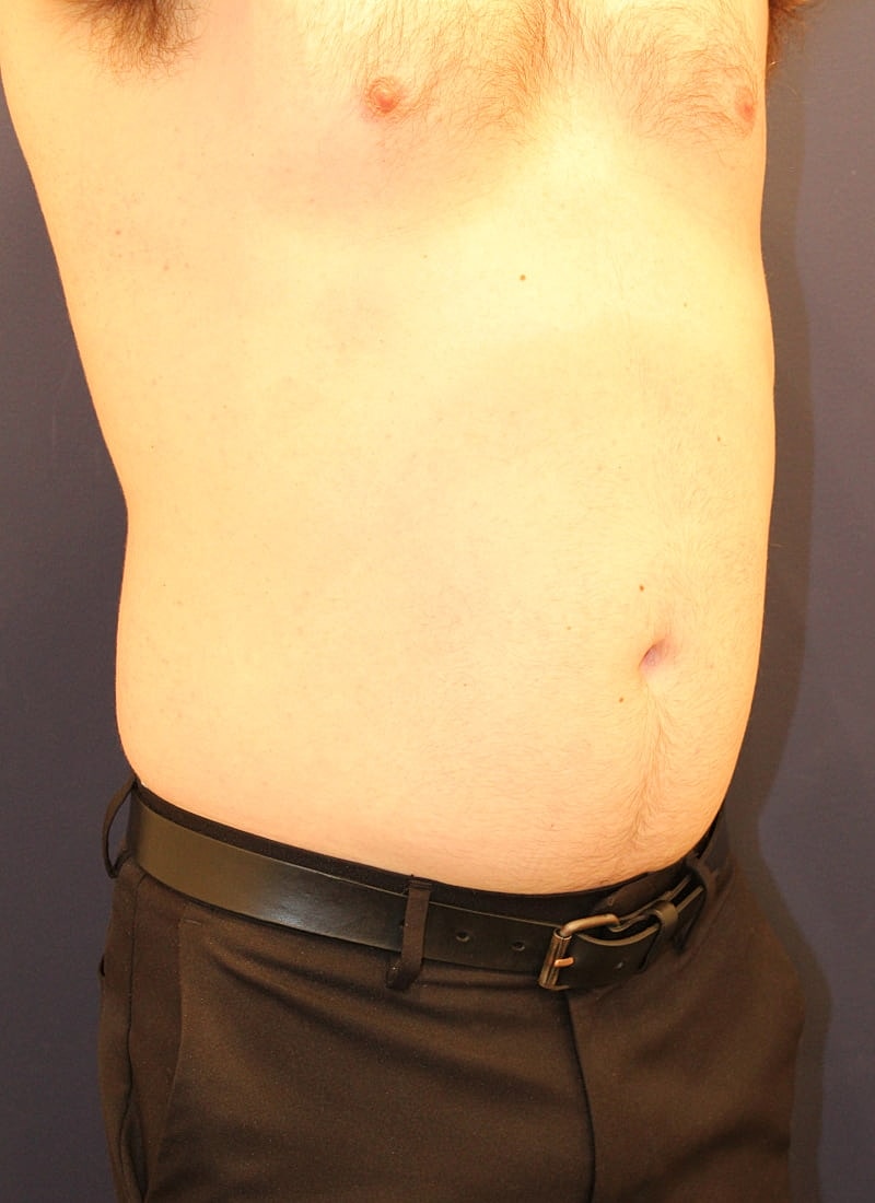 Emsculpt Neo Gallery Before & After