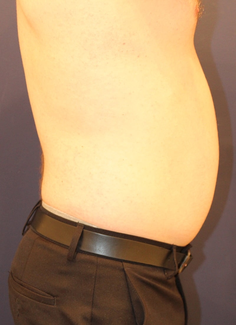 Emsculpt Neo Gallery Before & After