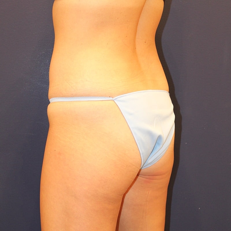 Emsculpt Neo Gallery Before & After